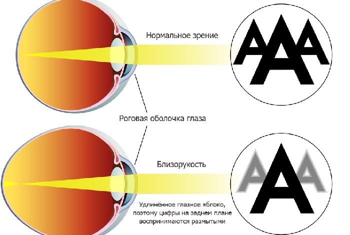 близорукость и нормальное зрение