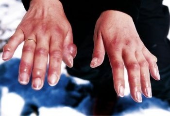Как лечить обморожение рук